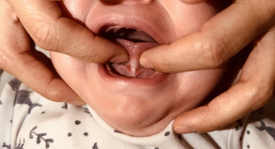 Begleitung bei oralen Restriktionen – Sabrina Beutel Stillberaterin